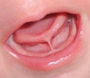 Tongue tie-Symptoms, causes and treatment