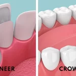 dental crowns vs veneers