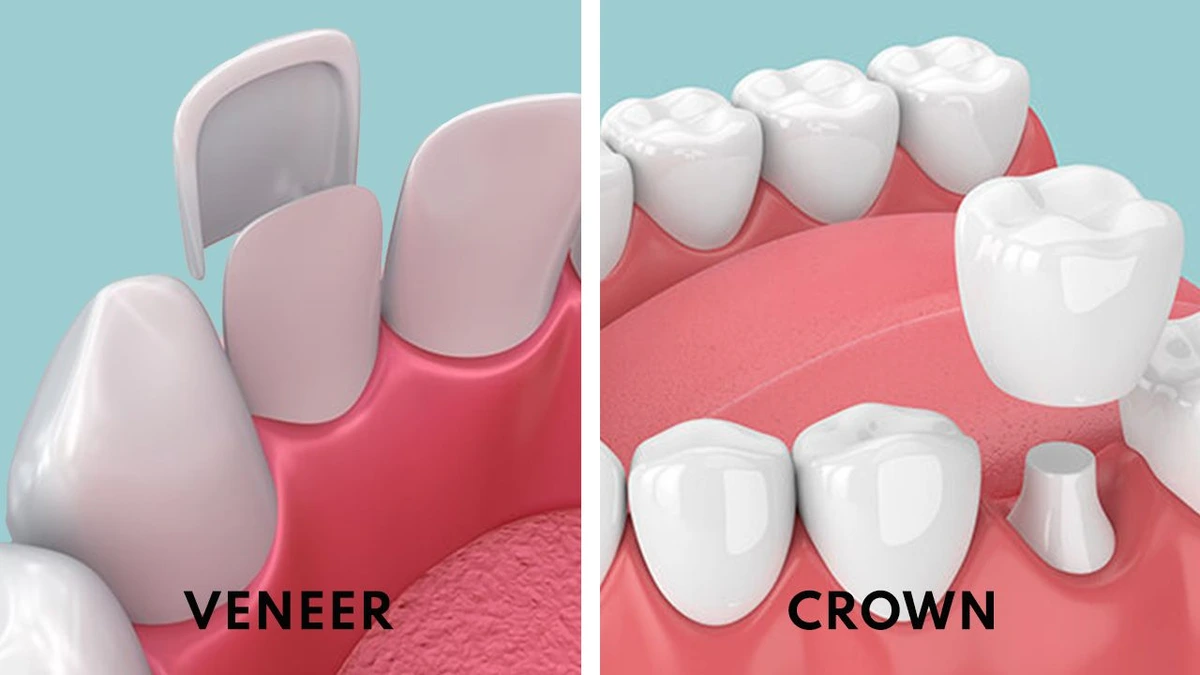 dental crowns vs veneers