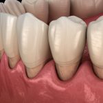 gum recession causes