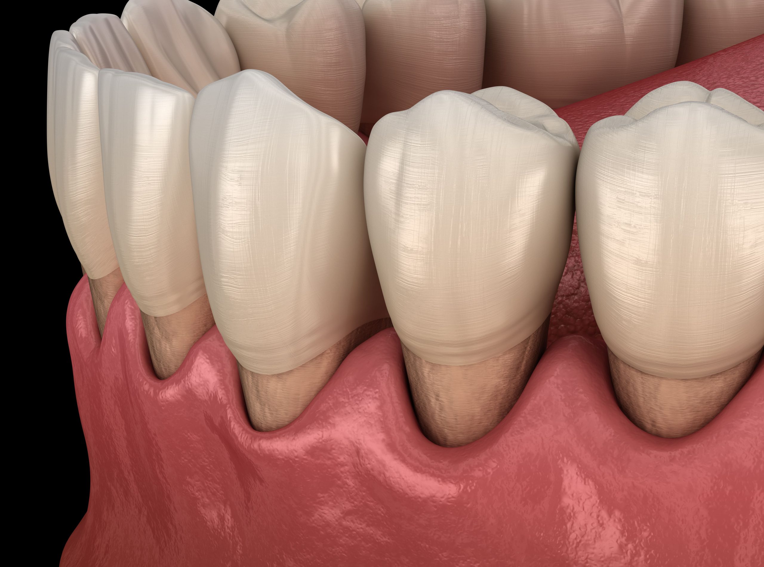gum recession causes
