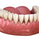 early signs of gum recession