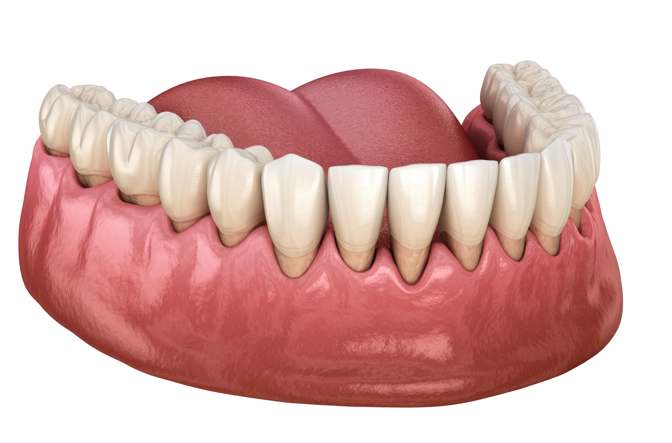 early signs of gum recession