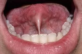 A typical adult tongue tie
