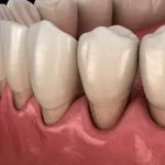 gum recession causes