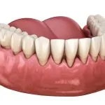 early signs of gum recession